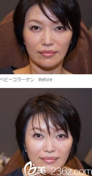 注射嬰兒膠原蛋白