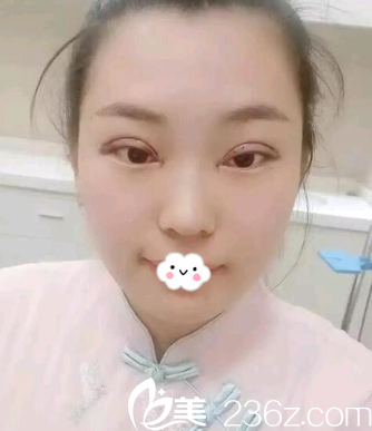 <!--<i data=20240703-sp></i>-->整形怎么樣？陳茂年雙眼皮<span style=