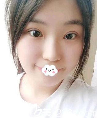 <!--<i data=20240703-sp></i>-->割雙眼皮怎么樣？陳茂年雙眼皮失敗修復(fù)真人<span style=