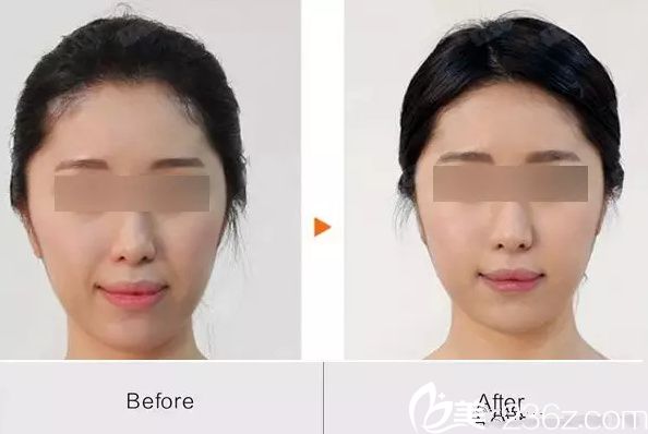 張紹斌自體脂肪填充法令紋案例 張紹斌自體脂肪填充法令紋案例