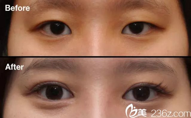 郭帥雙眼皮案例 郭帥雙眼皮案例