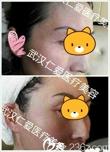 劉莉除皺針案例