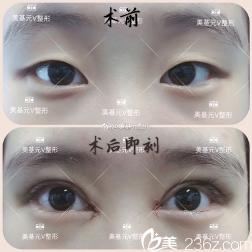 項利姣雙眼皮案例 項利姣雙眼皮案例