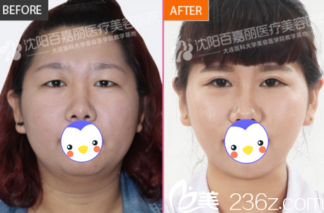 沈陽百嘉麗整形醫(yī)院雙眼皮真人案例