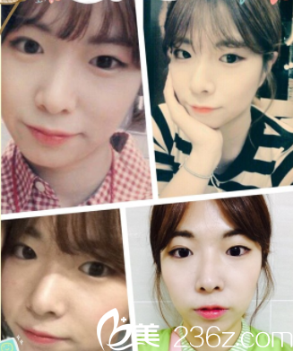 在韓國純真做眼整形前樣子 在韓國純真做眼整形前樣子