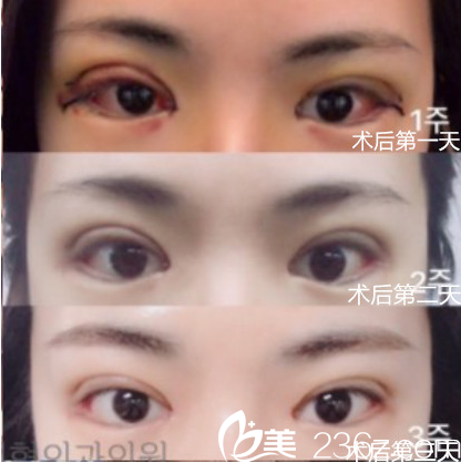 在韓國純真做眼整形恢復過程示意圖 在韓國純真做眼整形恢復過程示意圖