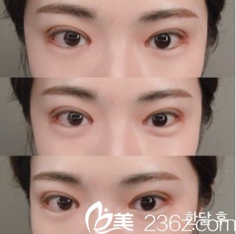 崔宰源醫(yī)生給我拆線后恢復組圖 崔宰源醫(yī)生給我拆線后恢復組圖