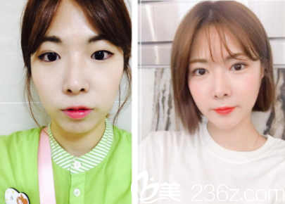 韓國純真眼整形術后一個月效果 韓國純真眼整形術后一個月效果