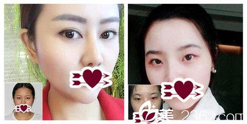 廣州美恩整形雙眼皮案例、超皮秒美膚案例