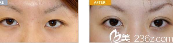 切開法雙眼皮 切開法雙眼皮
