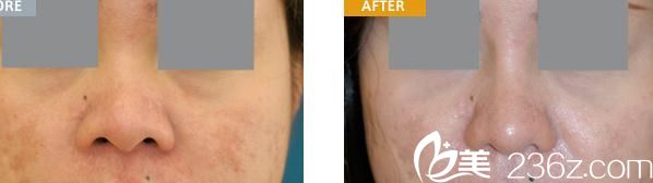 假體隆鼻 假體隆鼻