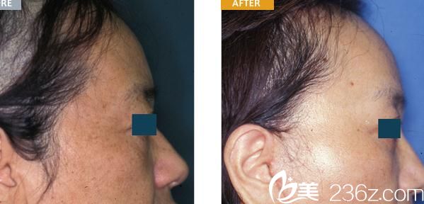 額頭提升 額頭提升