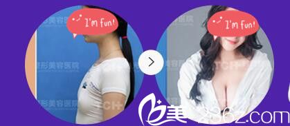 重慶時(shí)光整形醫(yī)院假體隆胸案例