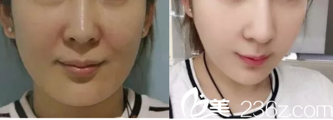 李在郁面部埋線提升案例 李在郁面部埋線提升案例