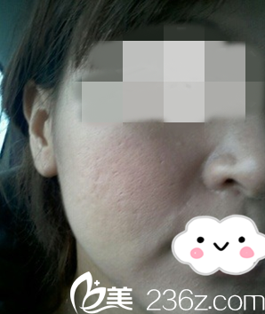 接受光子治療前的我 接受光子治療前的我