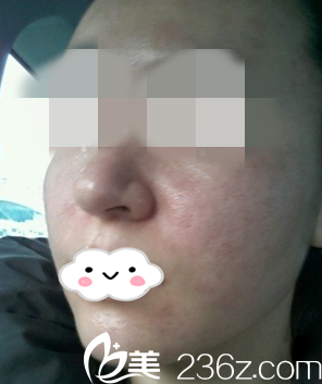 術(shù)后即刻的效果 術(shù)后即刻的效果