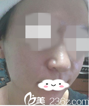 接受光子嫩膚二次治療的我 接受光子嫩膚二次治療的我