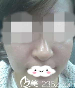 羨慕別人皮膚的我在佳木斯韓藝來做了三次光子嫩膚后達(dá)到了白白嫩嫩的效果