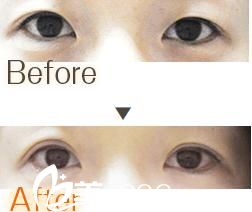 雙眼皮手術(shù)