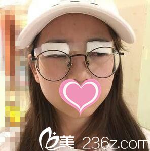 割雙眼皮術當天照