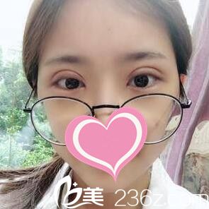 割雙眼皮術后第3天效果