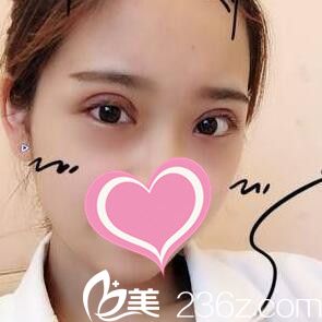 在沈陽安娜寶士麗割雙眼皮一周拆線