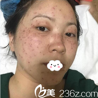 昆明韓辰激光祛斑效果怎么樣？