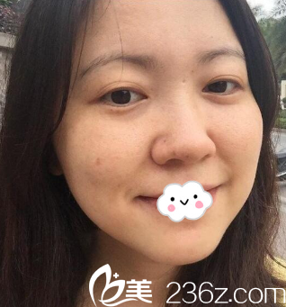 昆明韓辰周杰院長(zhǎng)激光祛斑術(shù)后15天真實(shí)恢復(fù)效果