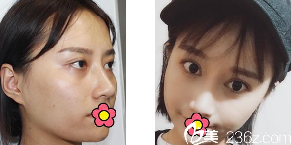 包頭麗人自體脂肪面部填充6個月的恢復(fù)效果案例