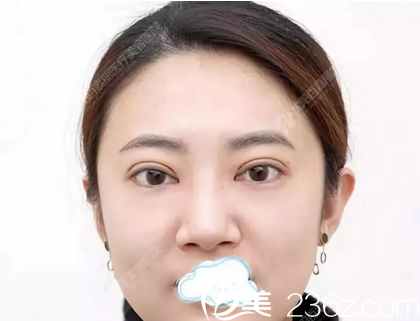 在沈陽做雙眼皮+開眼角術(shù)后當(dāng)天照 在沈陽做雙眼皮+開眼角術(shù)后當(dāng)天照