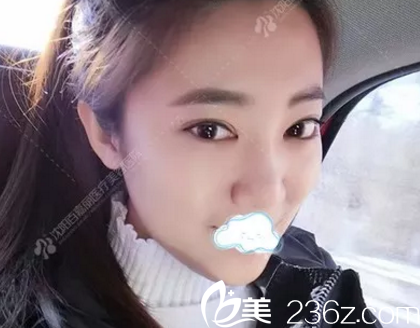 找沈陽百嘉麗汪曉蕾做雙眼皮開眼角術(shù)后3個月效果 找沈陽百嘉麗汪曉蕾做雙眼皮開眼角術(shù)后3個月效果