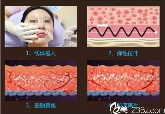 面部線雕的操作原理