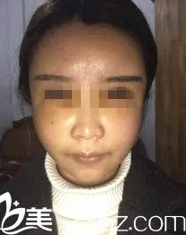 剛做完填充過后面部腫脹