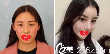 維多利亞張寶譽(yù)院長(zhǎng)雙眼皮案例