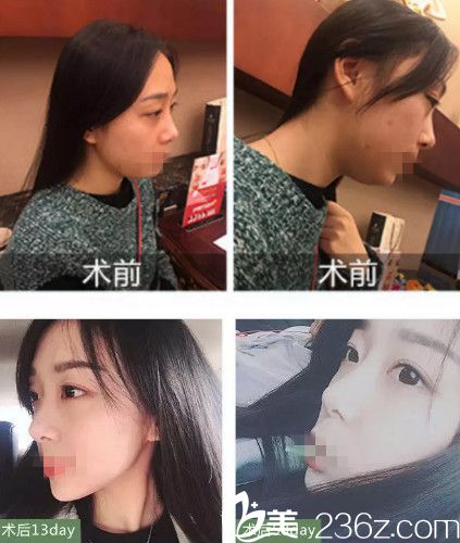 李成輝主任做肋軟骨隆鼻案例