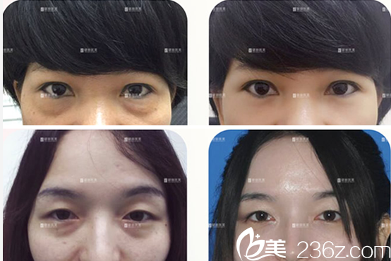 成都健麗趙波濤去眼袋案例 成都健麗趙波濤去眼袋案例