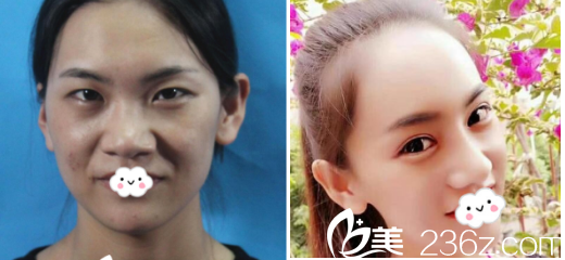 朱建瑩醫(yī)生眼部整形案例