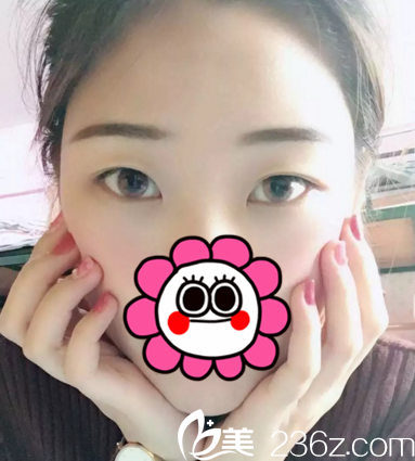 在長春中妍做雙眼皮+開眼角術(shù)前 在長春中妍做雙眼皮+開眼角術(shù)前