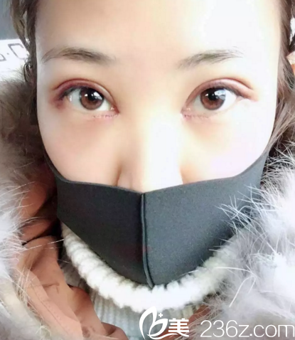 在長春中妍做雙眼皮+開眼角術(shù)后2天 在長春中妍做雙眼皮+開眼角術(shù)后2天