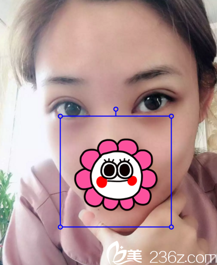 在長春中妍做雙眼皮+開眼角術(shù)后10天 在長春中妍做雙眼皮+開眼角術(shù)后10天