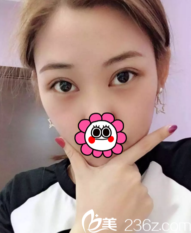 在長春中妍做雙眼皮+開眼角術(shù)后15天 在長春中妍做雙眼皮+開眼角術(shù)后15天