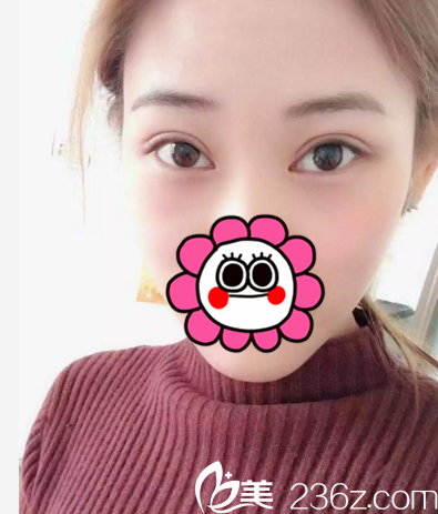 在長春中妍做雙眼皮+開眼角術(shù)后21天 在長春中妍做雙眼皮+開眼角術(shù)后21天