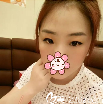 做雙眼皮術前照片 做雙眼皮術前照片