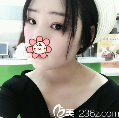 鐳射定點定位雙眼皮術后5天 鐳射定點定位雙眼皮術后5天