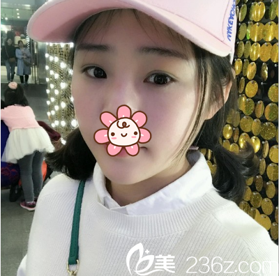 成都健麗雙眼皮術后半個月 成都健麗雙眼皮術后半個月