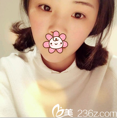 趙波濤定點雙眼皮術后一個月 趙波濤定點雙眼皮術后一個月