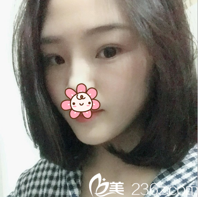 鐳射定點定位雙眼皮術后2個月 鐳射定點定位雙眼皮術后2個月