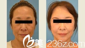 整體拉皮手術(shù)