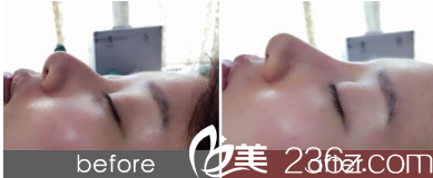 淮北時光假體隆鼻真人案例