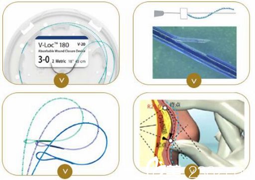 蘇州康美可做的線雕隆鼻采用蛋白線
